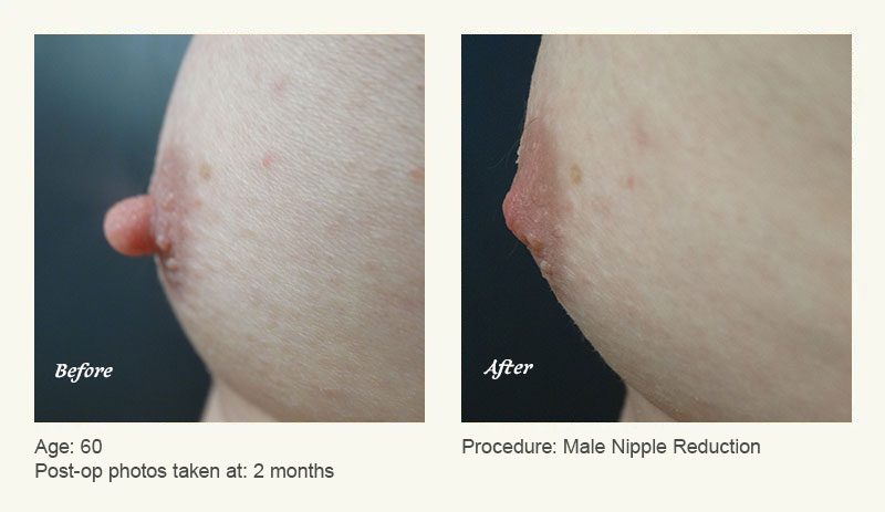 Male Nipple Reduction in Plano, TX - Patient 4