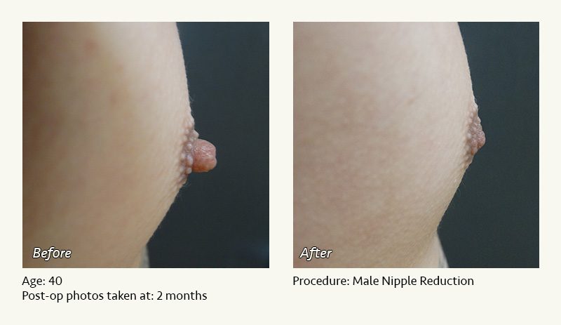 Male Nipple Reduction in Plano, TX - Patient 2