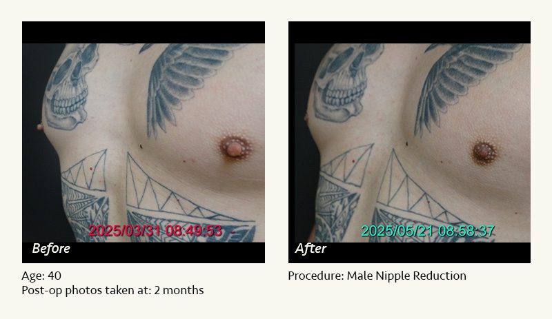 Male Nipple Reduction in Plano, TX - Patient 1