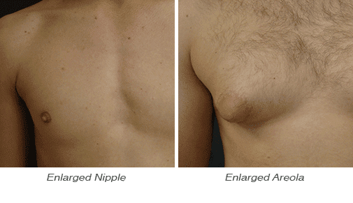Is It Possible To Re-Size And Re-Shape Your Nipples And Areola? | Andrew Barnett Md
