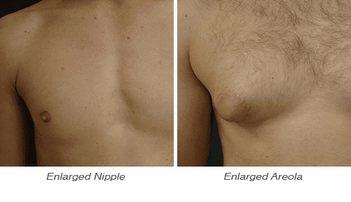 male nipple reduction