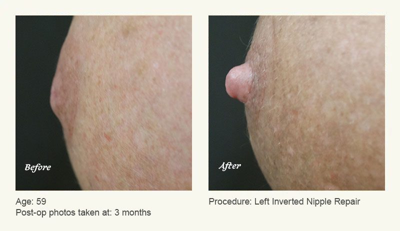 Nipple Procedures (Female) in Plano, TX - Patient 2
