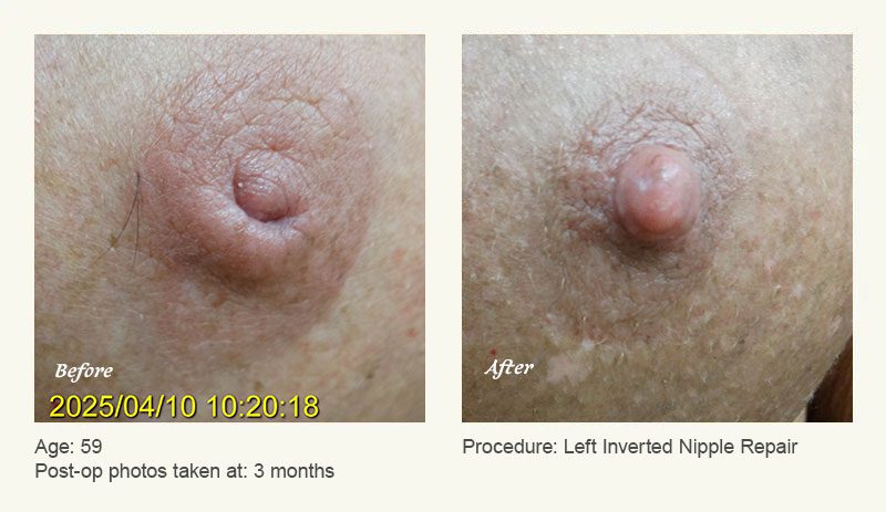 Nipple Procedures (Female) in Plano, TX - Patient 1