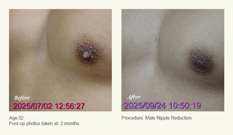 Male Nipple Reduction in Plano, TX - Patient 4