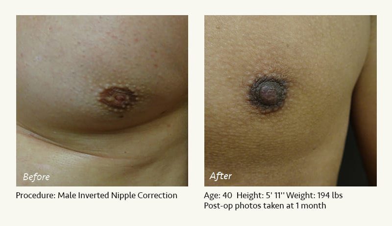 Male Nipple Reduction in Plano, TX - Patient 22