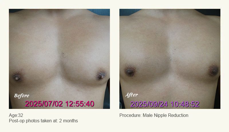Male Nipple Reduction in Plano, TX - Patient 3