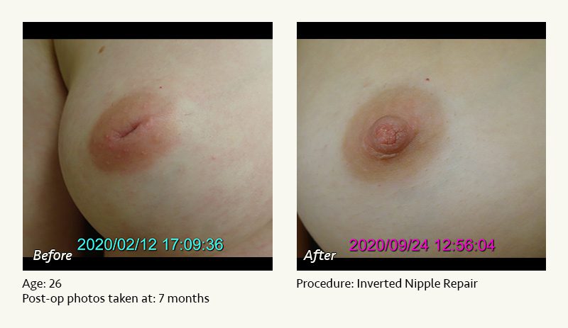 Nipple Procedures (Female) in Plano, TX - Patient 18