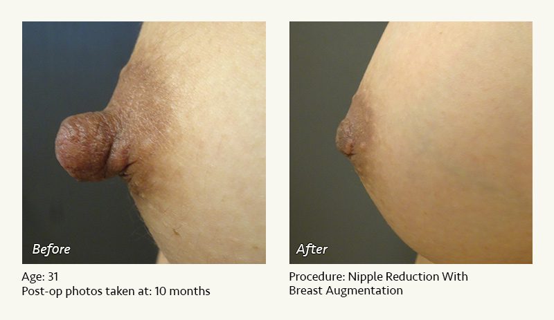 Nipple Procedures (Female) in Plano, TX - Patient 17