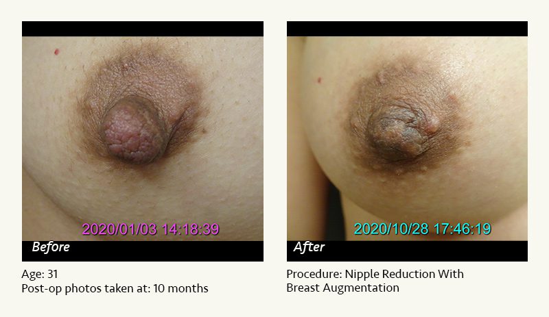 Nipple Procedures (Female) in Plano, TX - Patient 16
