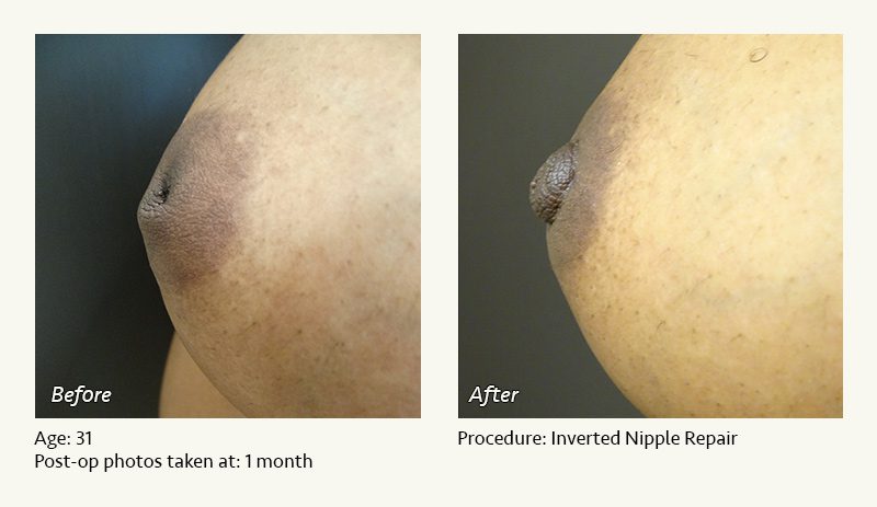 Nipple Procedures (Female) in Plano, TX - Patient 13