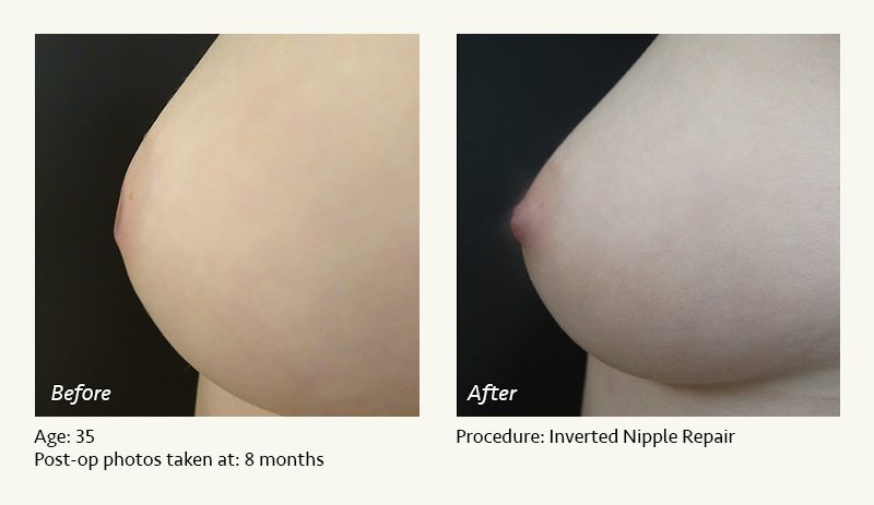 Nipple Procedures (Female) in Plano, TX - Patient 15