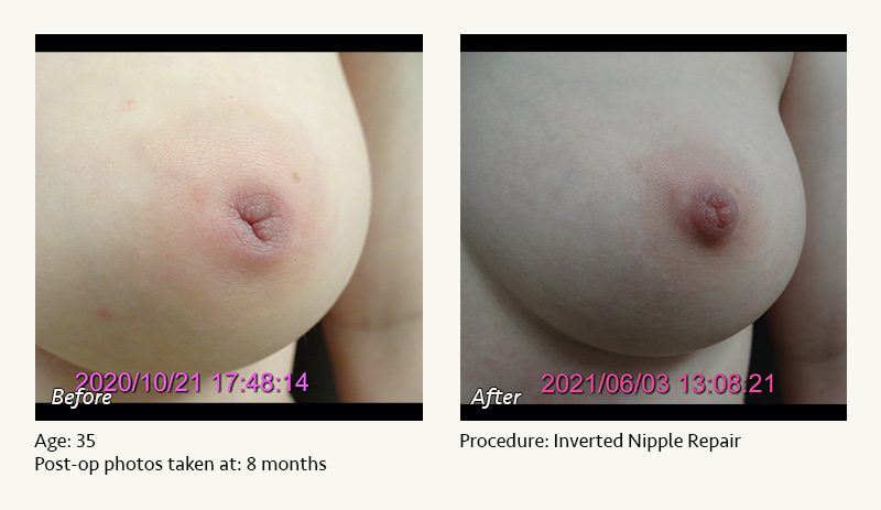 Nipple Procedures (Female) in Plano, TX - Patient 14