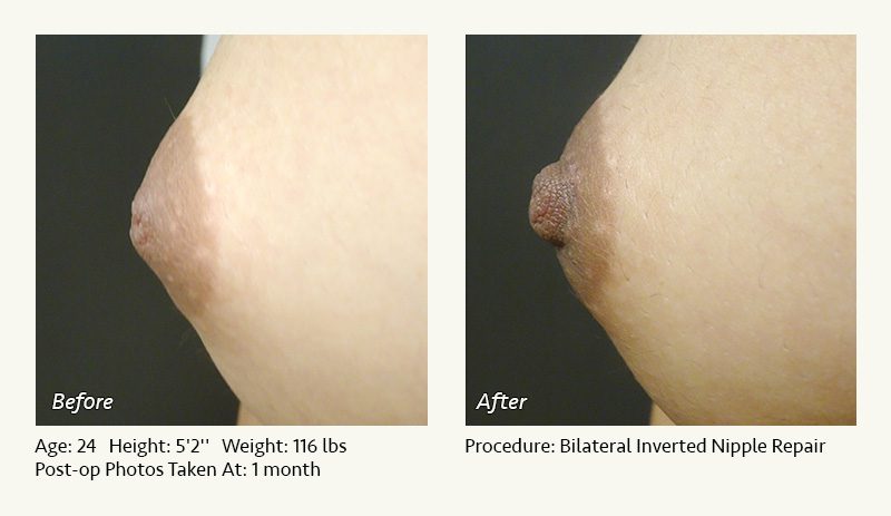 Nipple Procedures (Female) in Plano, TX - Patient 9