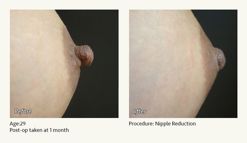 Nipple Procedures (Female) in Plano, TX - Patient 25
