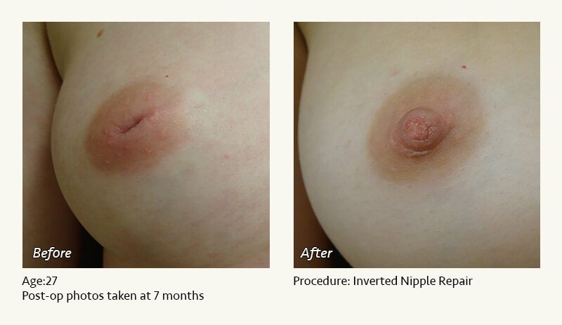 Nipple Procedures (Female) in Plano, TX - Patient 24