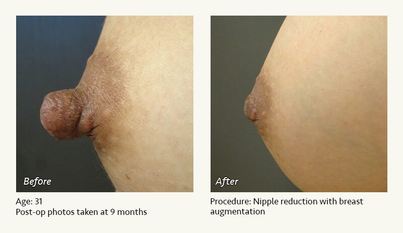Nipple Procedures (Female) in Plano, TX - Patient 23