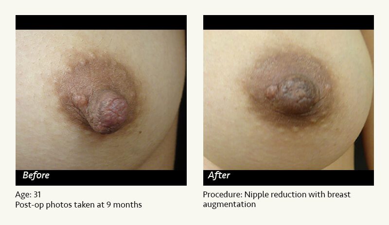 Nipple Procedures (Female) in Plano, TX - Patient 22
