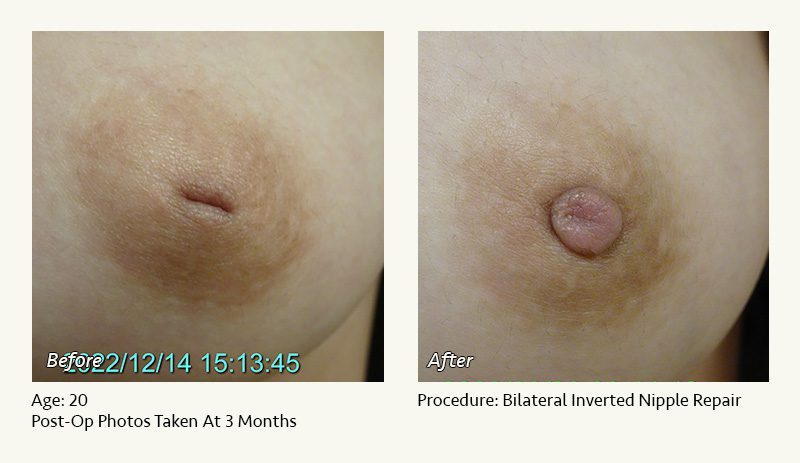 Nipple Procedures (Female) in Plano, TX - Patient 6