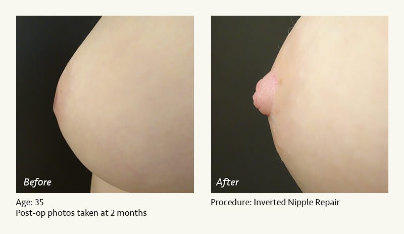 Nipple Procedures (Female) in Plano, TX - Patient 21