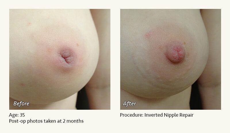 Nipple Procedures (Female) in Plano, TX - Patient 20