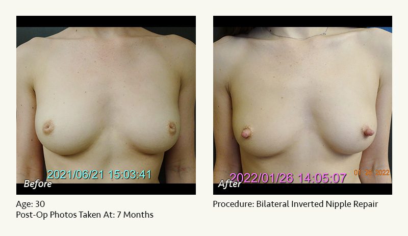 Nipple Procedures (Female) in Plano, TX - Patient 4