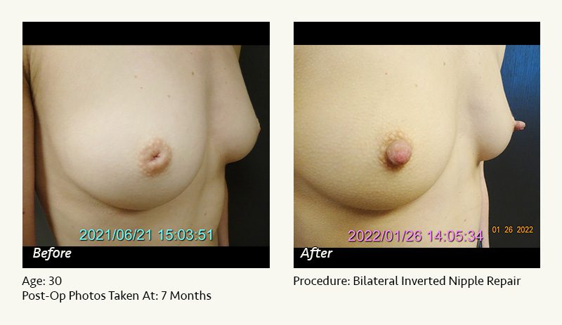 Nipple Procedures (Female) in Plano, TX - Patient 5