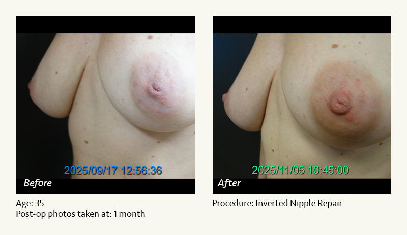 Nipple Procedures (Female) in Plano, TX - Patient 1
