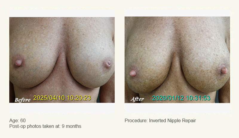 Nipple Procedures (Female) in Plano, TX - Patient 2