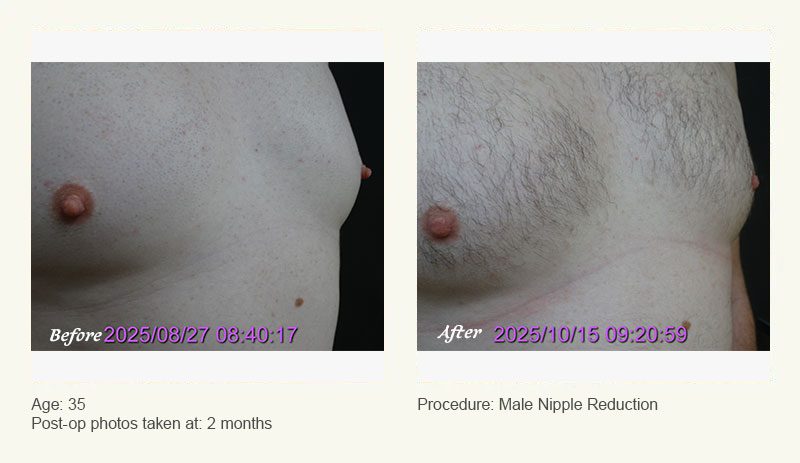 Male Nipple Reduction in Plano, TX - Patient 1
