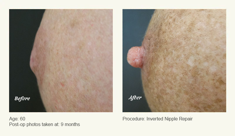 Nipple Procedures (Female) in Plano, TX - Patient 1