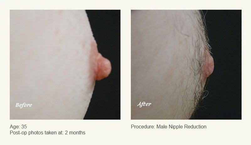 Male Nipple Reduction in Plano, TX - Patient 2