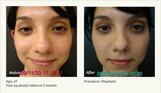 Otoplasty | Ear Pinning Surgery in Plano, TX - Patient 14