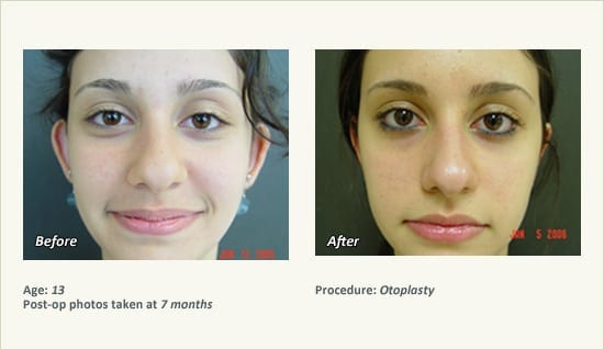 Otoplasty | Ear Pinning Surgery in Plano, TX - Patient 10