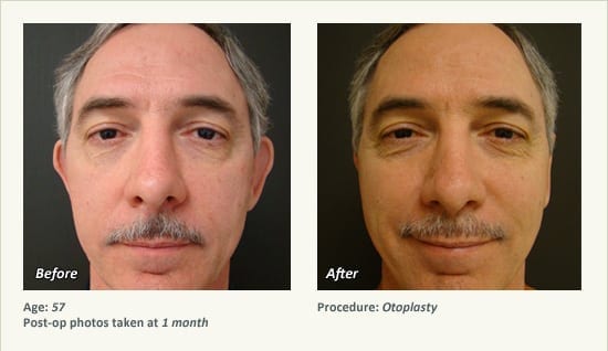 Otoplasty | Ear Pinning Surgery in Plano, TX - Patient 17