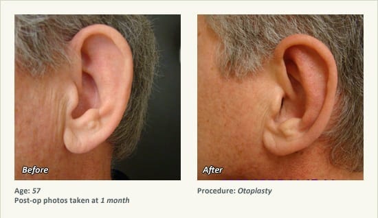 Otoplasty | Ear Pinning Surgery in Plano, TX - Patient 18