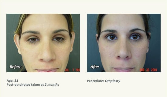 Otoplasty | Ear Pinning Surgery in Plano, TX - Patient 13