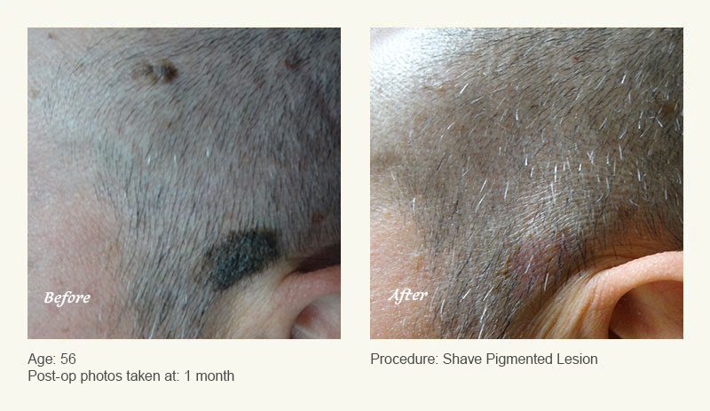 Reconstructive Surgery in Plano, TX - Patient 3
