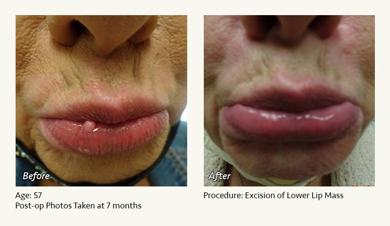 Reconstructive Surgery in Plano, TX - Patient 4