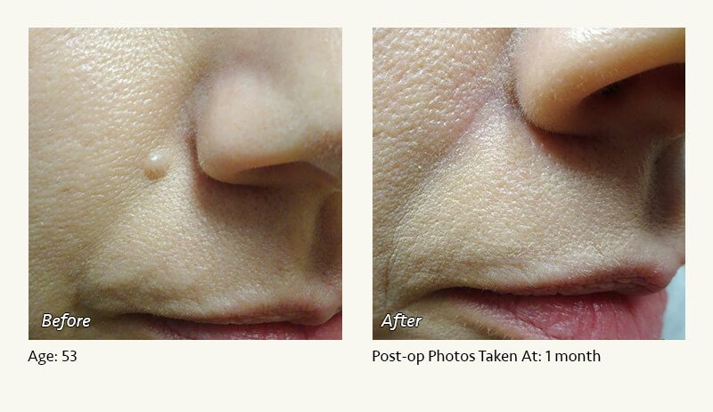 Reconstructive Surgery in Plano, TX - Patient 2