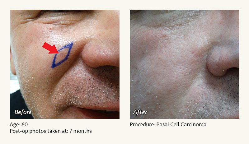 Reconstructive Surgery in Plano, TX - Patient 1