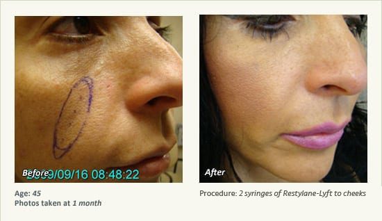 Restylane® & JUVÉDERM® Gel Injectable Fillers In Plano, TX - Patient 28