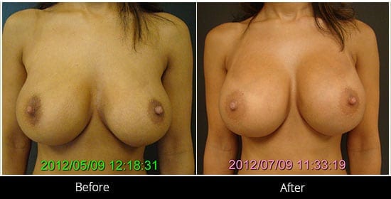 Breast Implant Revision Before & After 10 Front