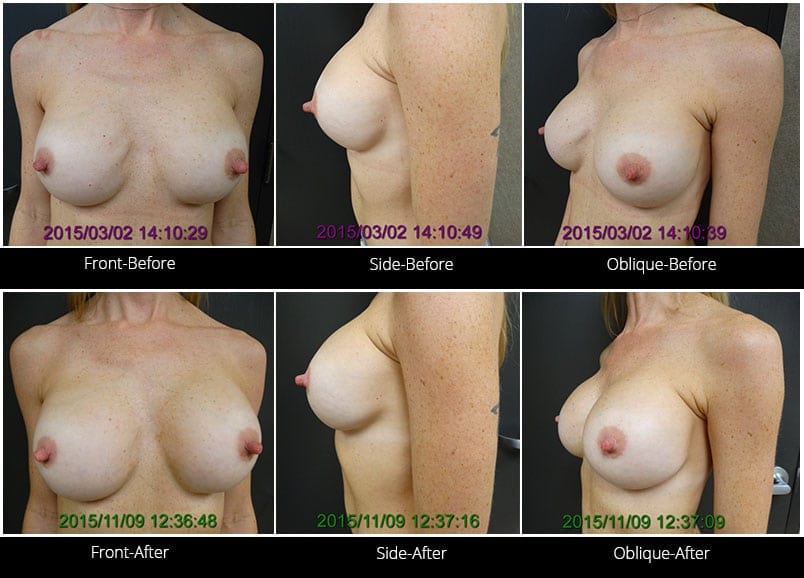 Breast Implant Revision Before & After 11 Full