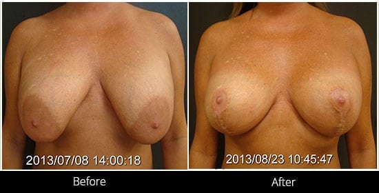 Breast Implant Revision Before & After 12 Front