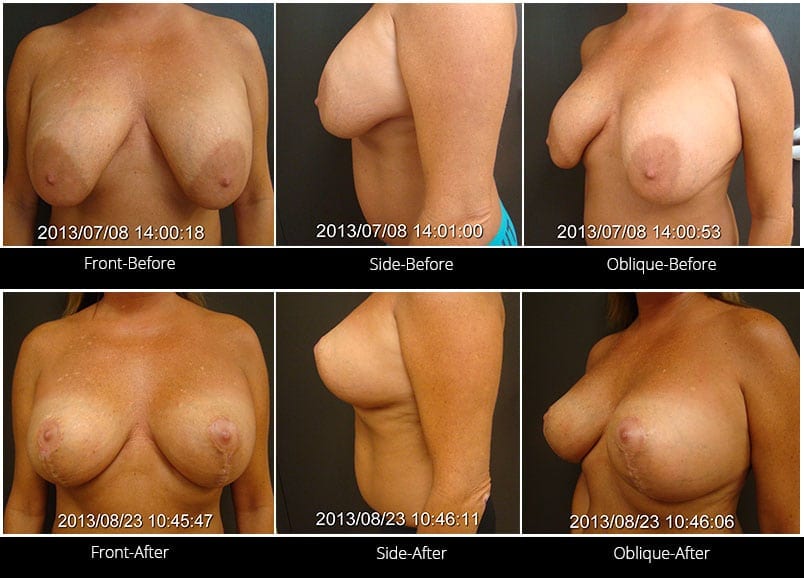 Breast Implant Revision Before & After 12 Full