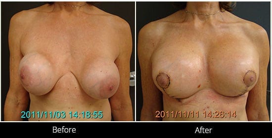 Breast Implant Revision Before & After 13 Front