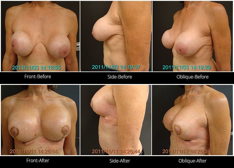 Breast Implant Revision Before & After 13 Full