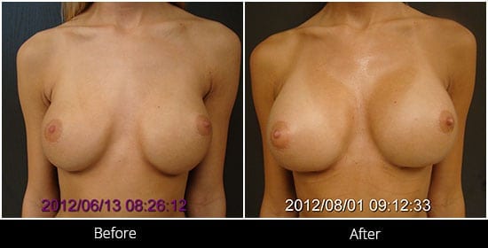 Breast Implant Revision Before & After 1 Front