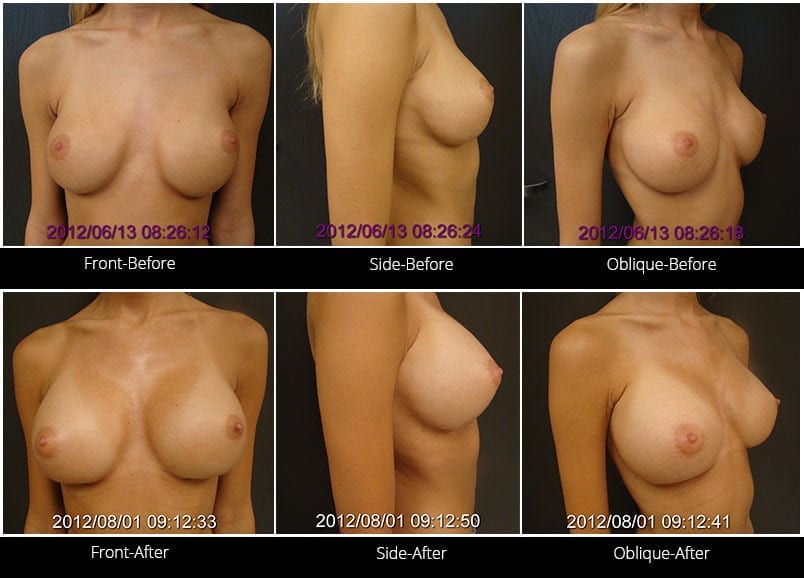 Breast Implant Revision Before & After 1 Full