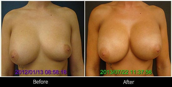 Breast Implant Revision Before & After 2 Front